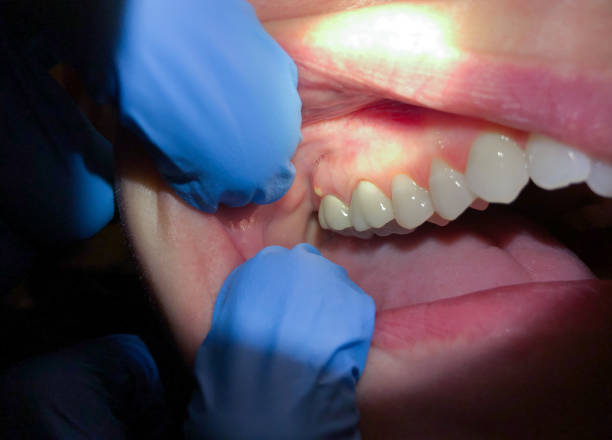 Best Emergency Wisdom Teeth Removal in Arcadia, SC
